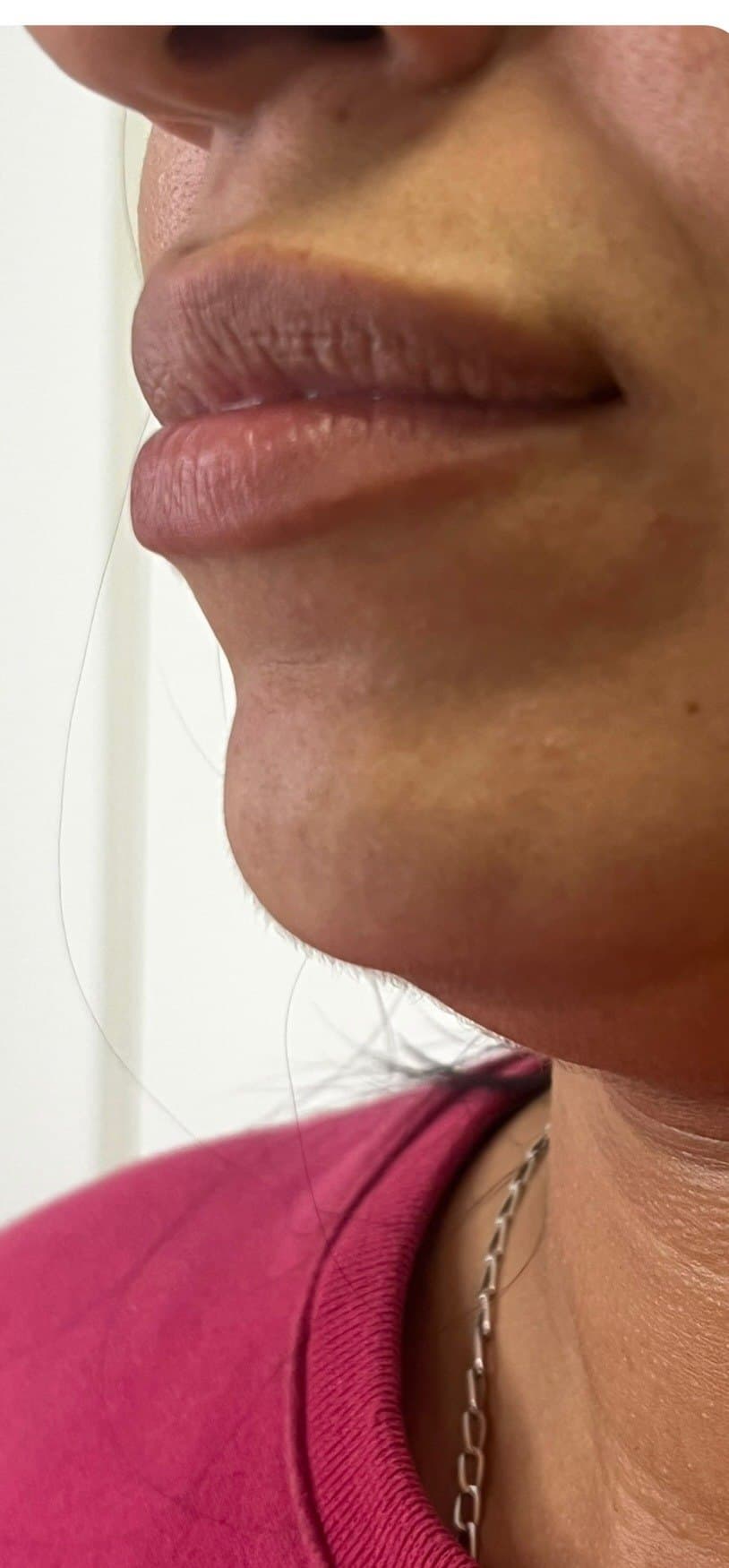 Antes · Preenchimento labial