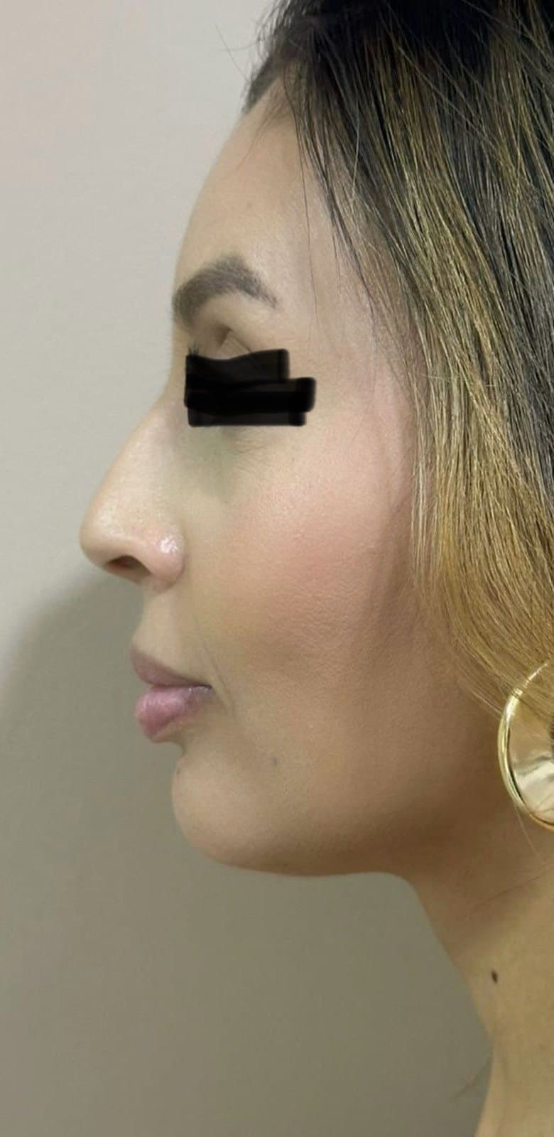 Antes · Harmonização facial