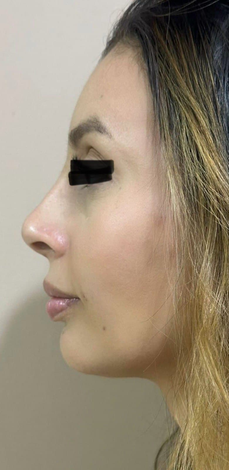 Depois · Harmonização facial