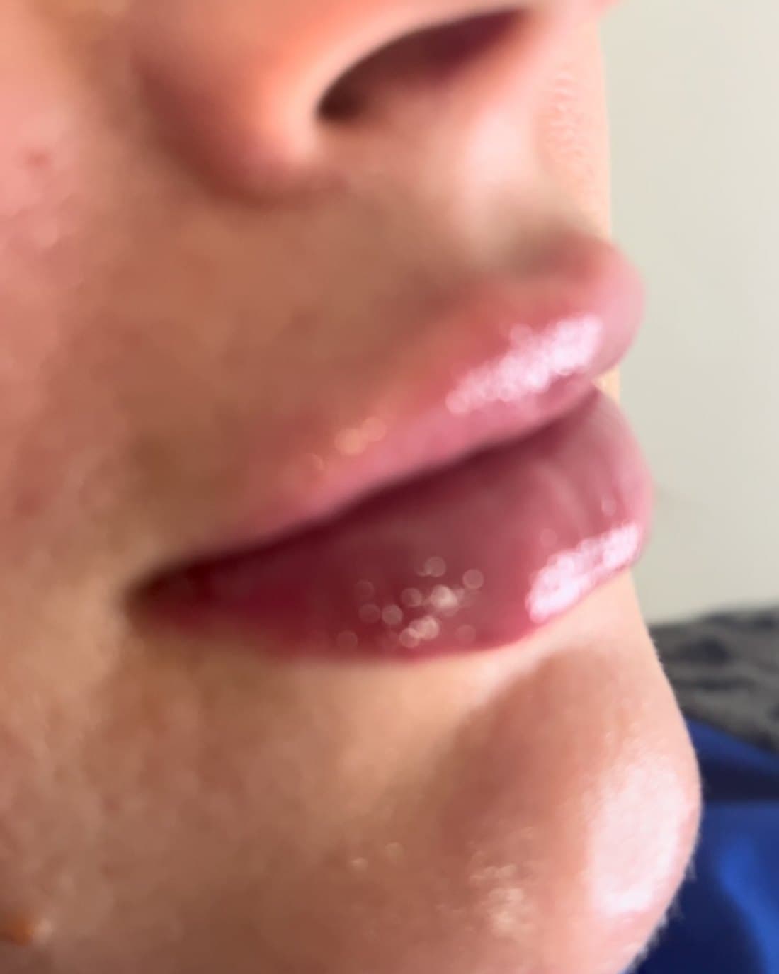 Preenchimento Labial